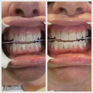/img/25703-teeth-whitening-boynton-beach-fl-7.webp