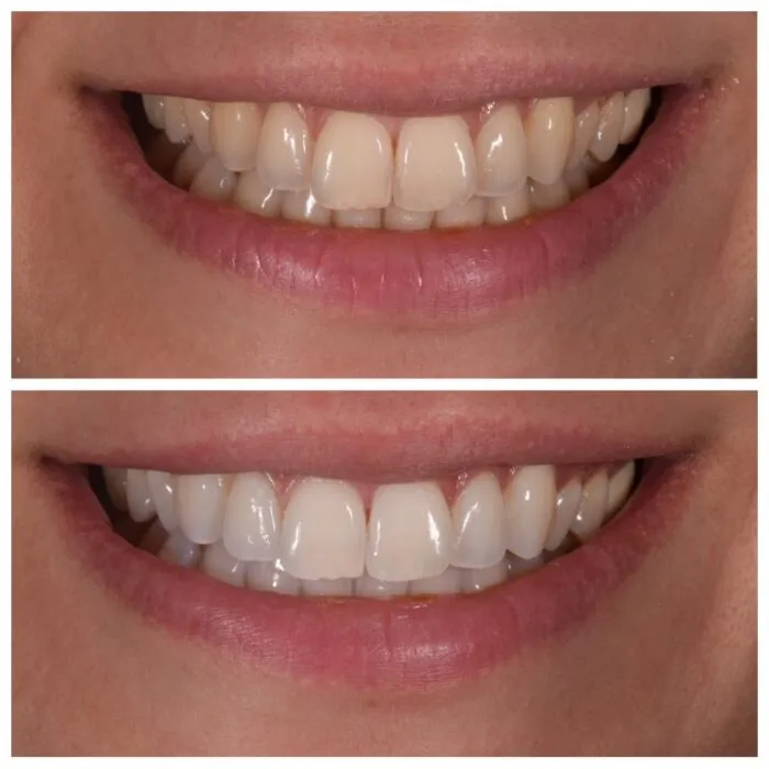 25706 sensitive teeth tips