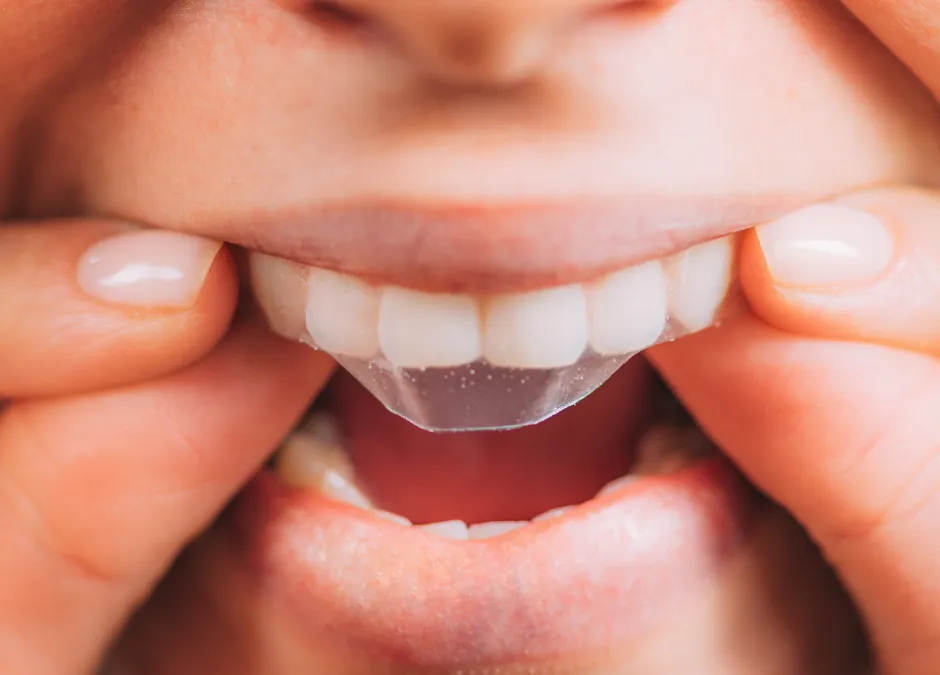 /img/25710-teeth-whitening-comparison.webp