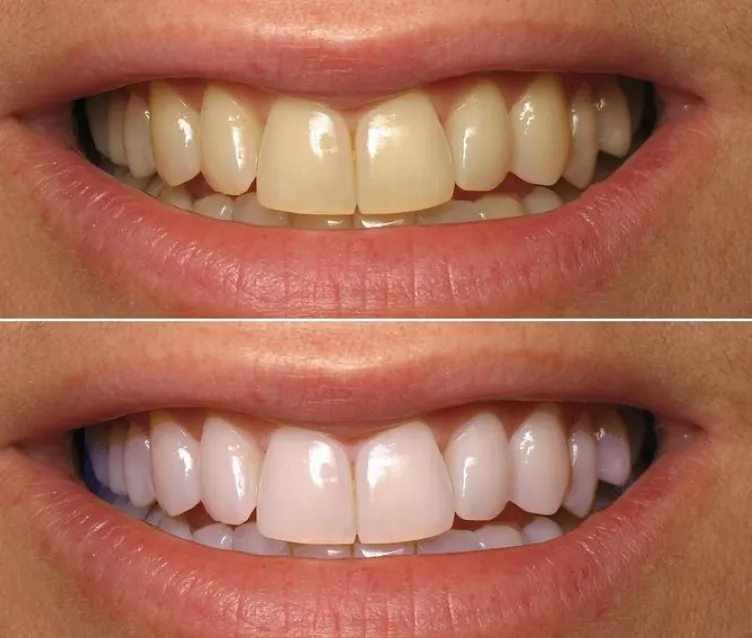 25710 teeth whitening results
