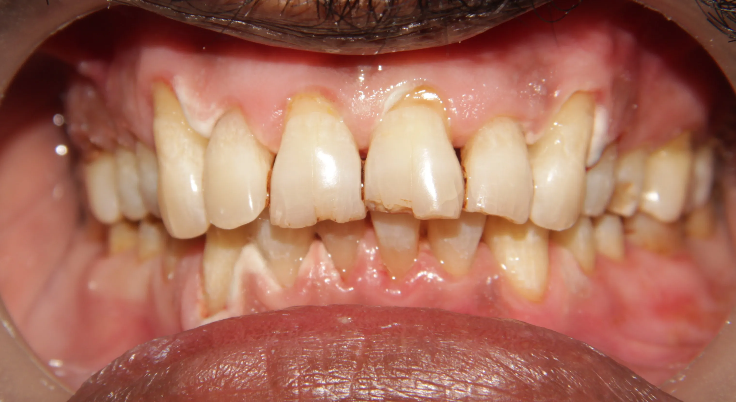 25712 at home teeth whitening kits