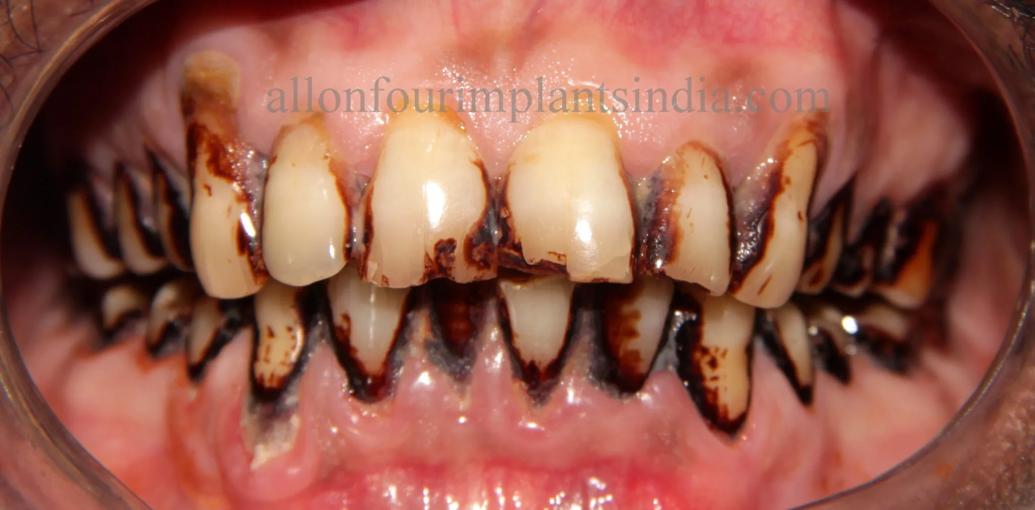 25712 teeth whitening procedure cost