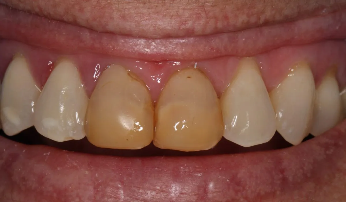 25713 kor whitening gum health