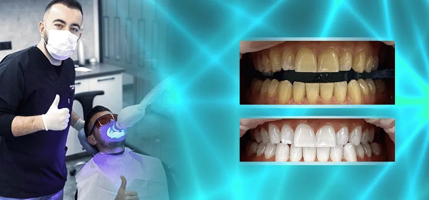 25719 teeth whitening little rock ar types