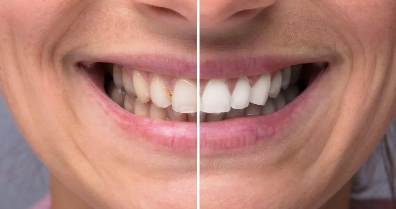 25722 cracked tooth