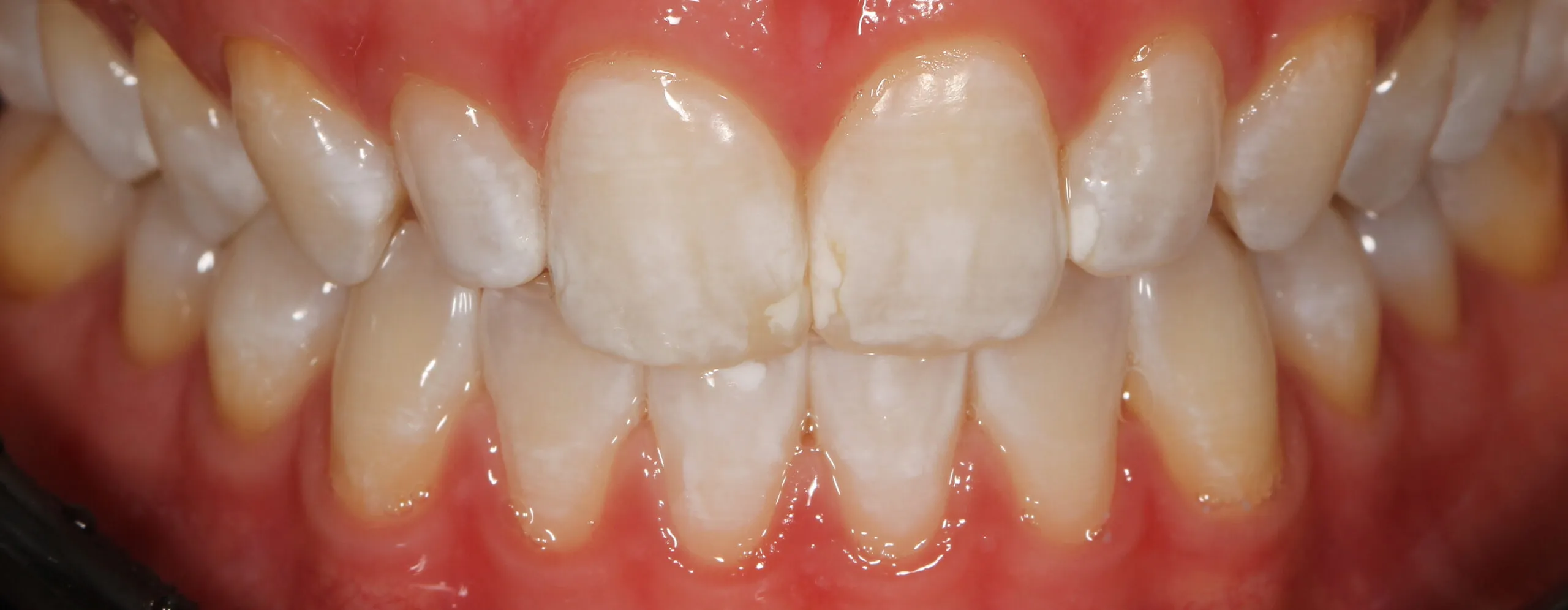 25722 receding gums