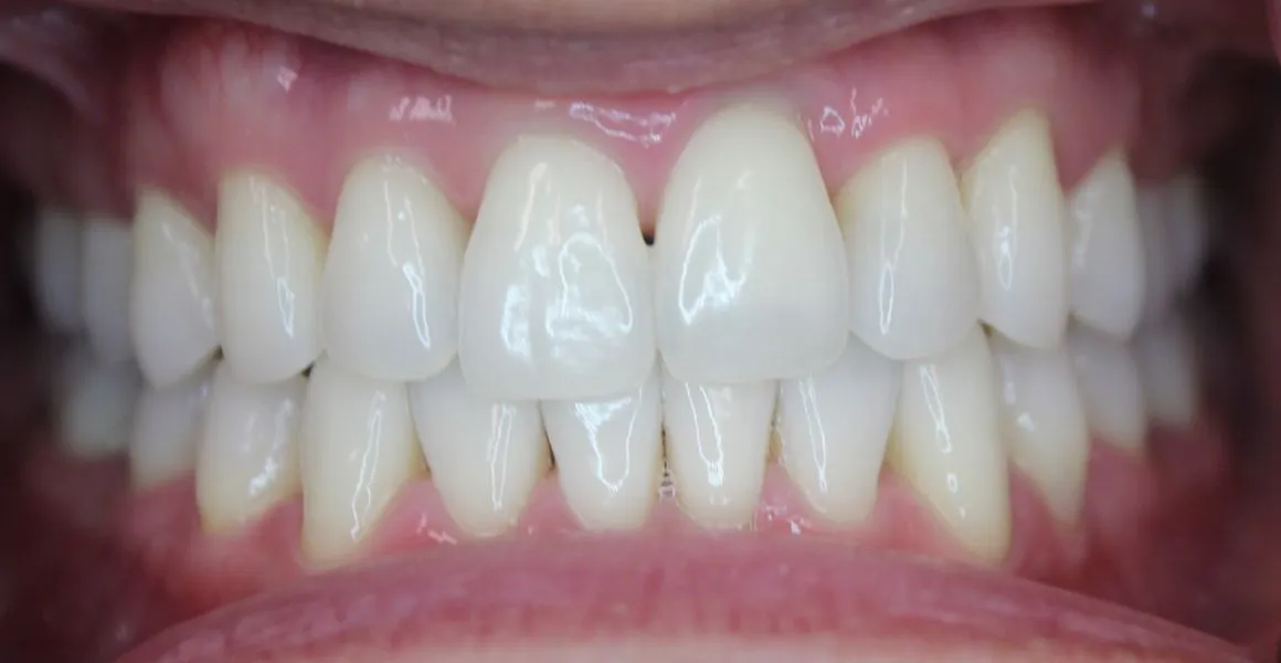 25725 teeth whitening options