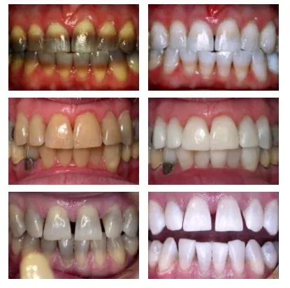25733 enamel hypoplasia