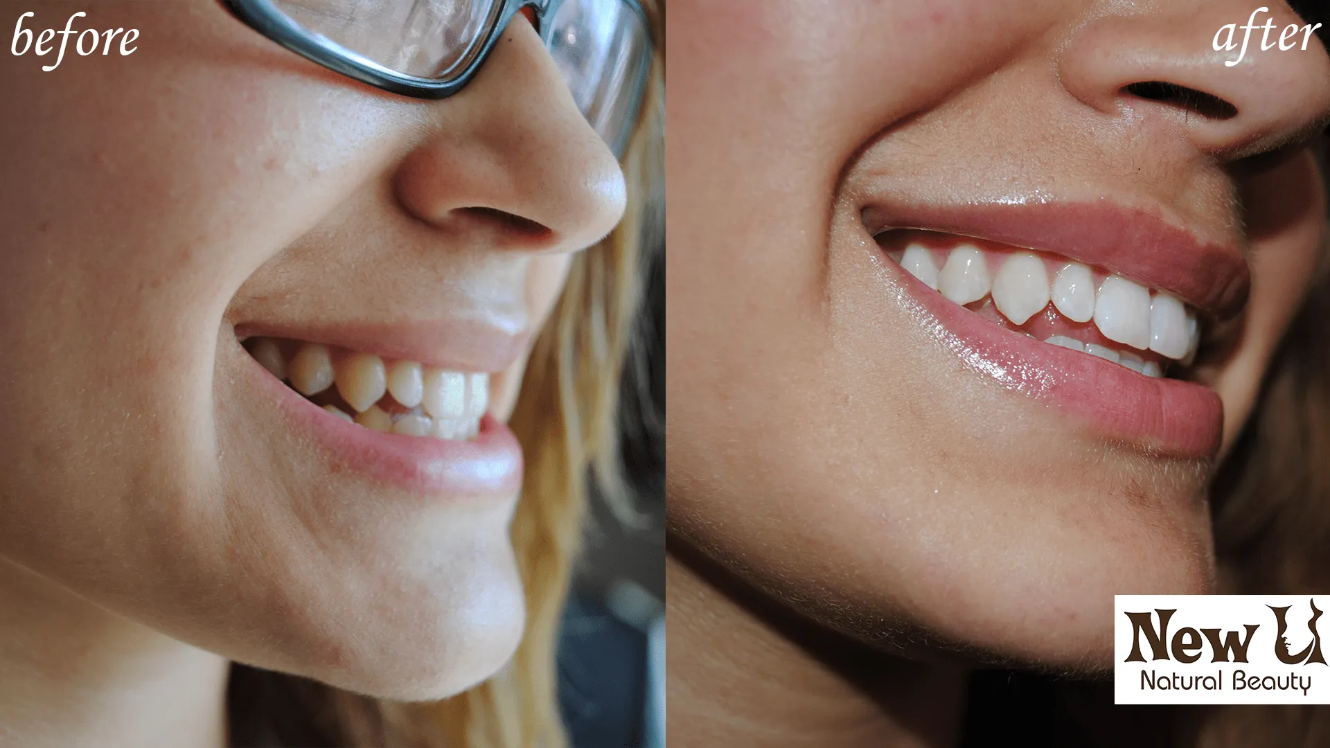 25736 teeth whitening comparison