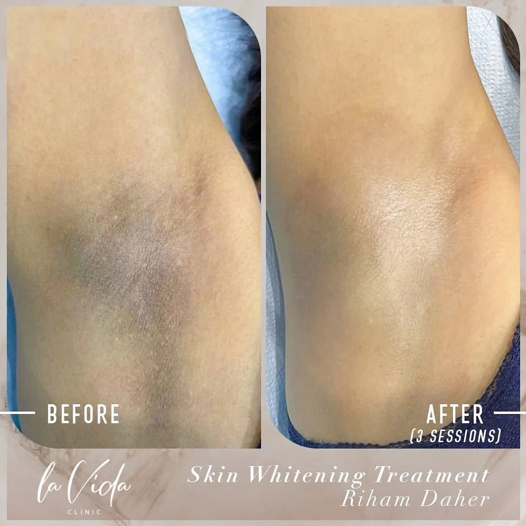 25738 professional teeth whitening