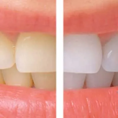 25741 professional teeth whitening