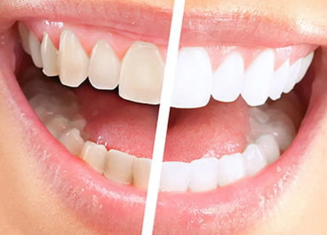 25742 teeth whitening sensitivity 2