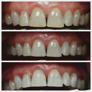 /img/25743-teeth-whitening-bradenton-fl-smile.webp