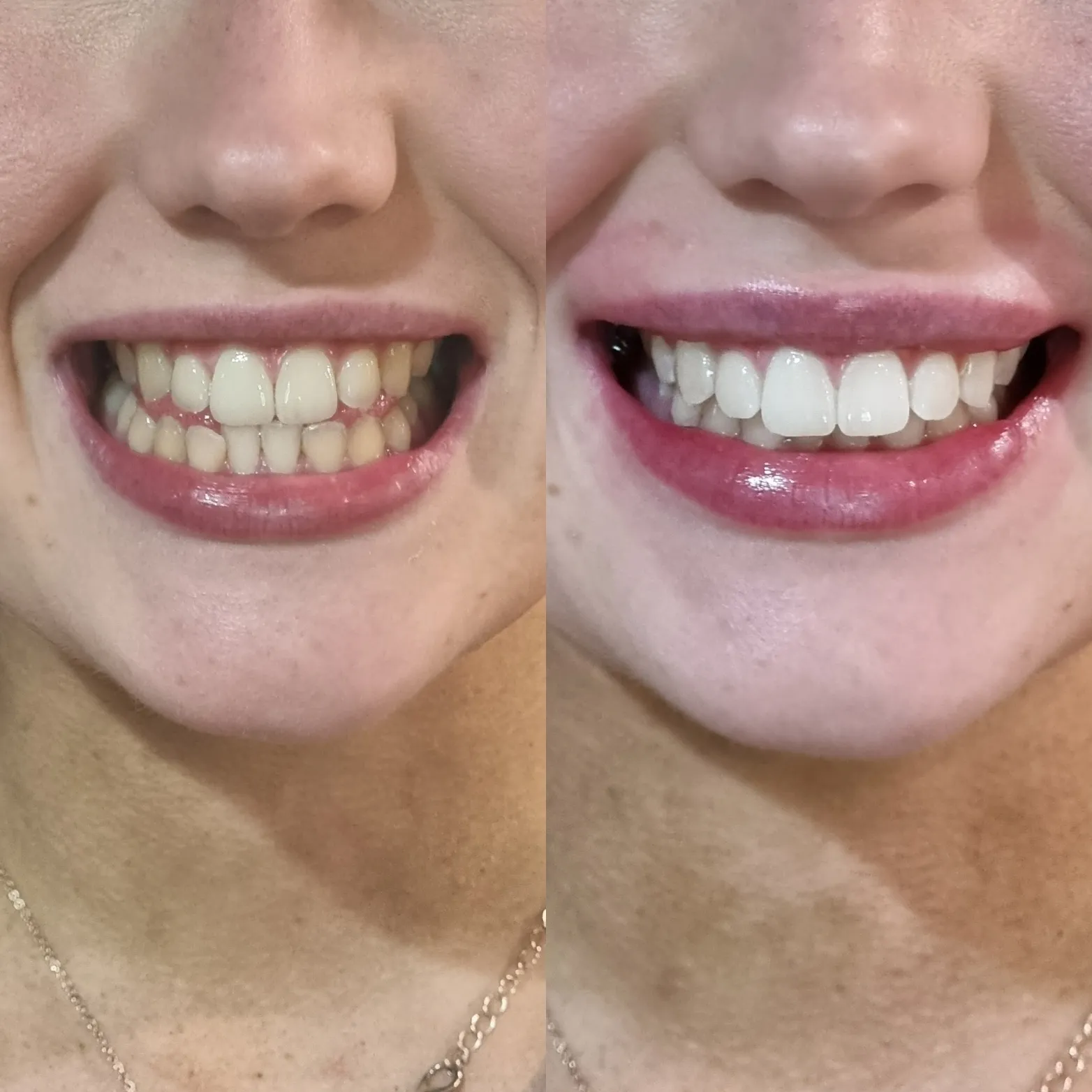 25744 teeth whitening melbourne deals 2
