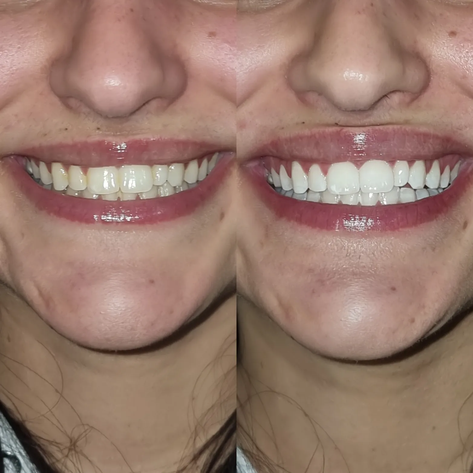 25744 teeth whitening melbourne deals 4