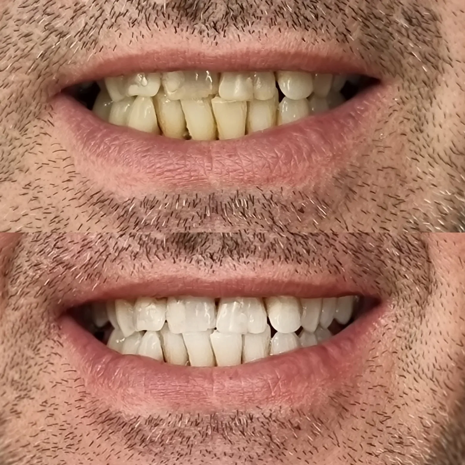 25744 teeth whitening melbourne deals 5