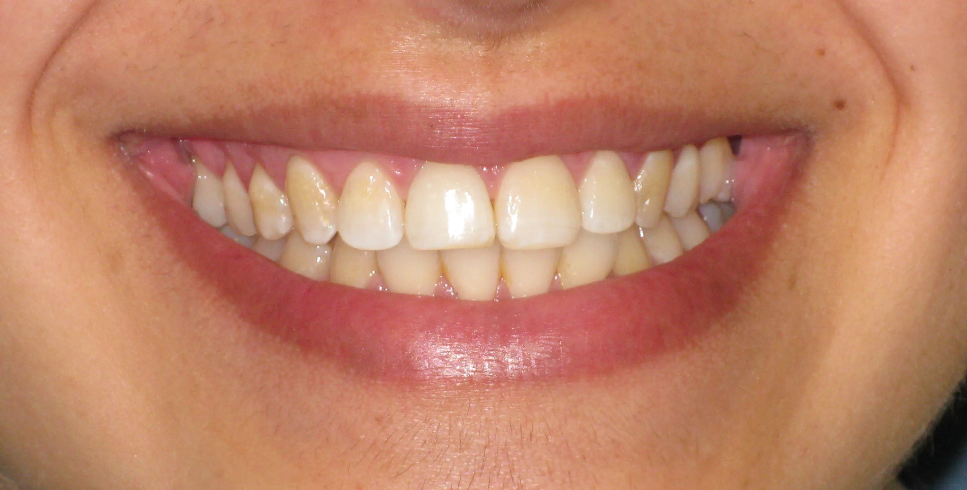 25745 gentle brushing