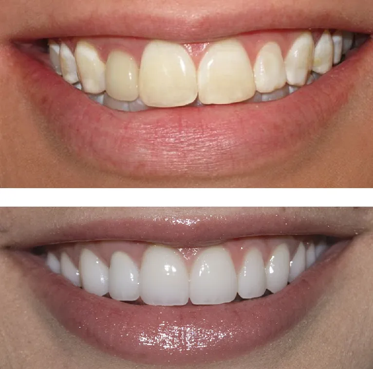 25745 whitening process