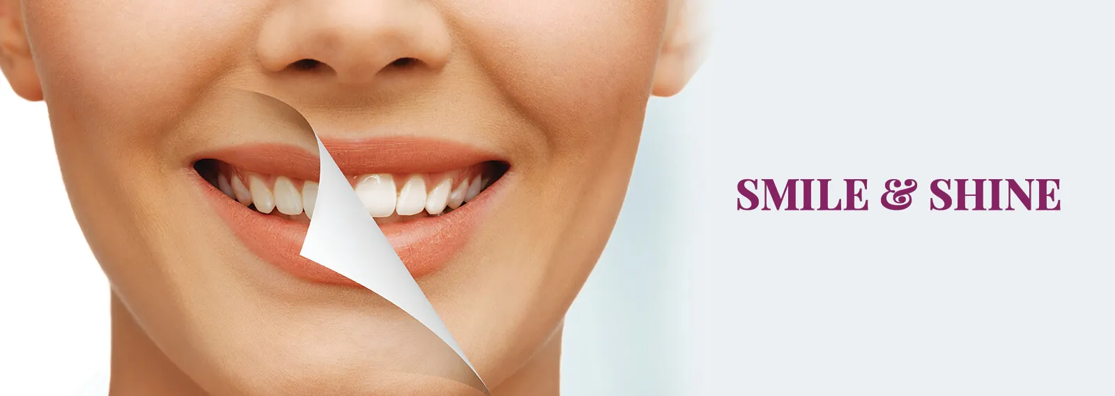25755 home teeth whitening kits