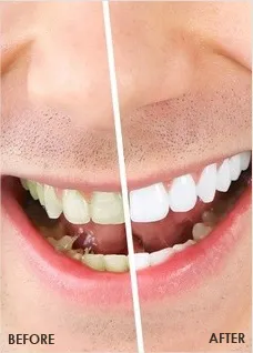 25756 fresno teeth whitening in office