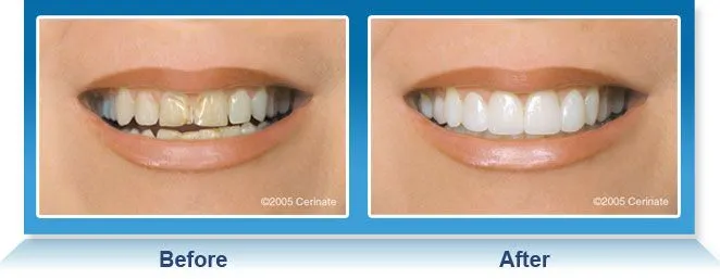25756 fresno teeth whitening products
