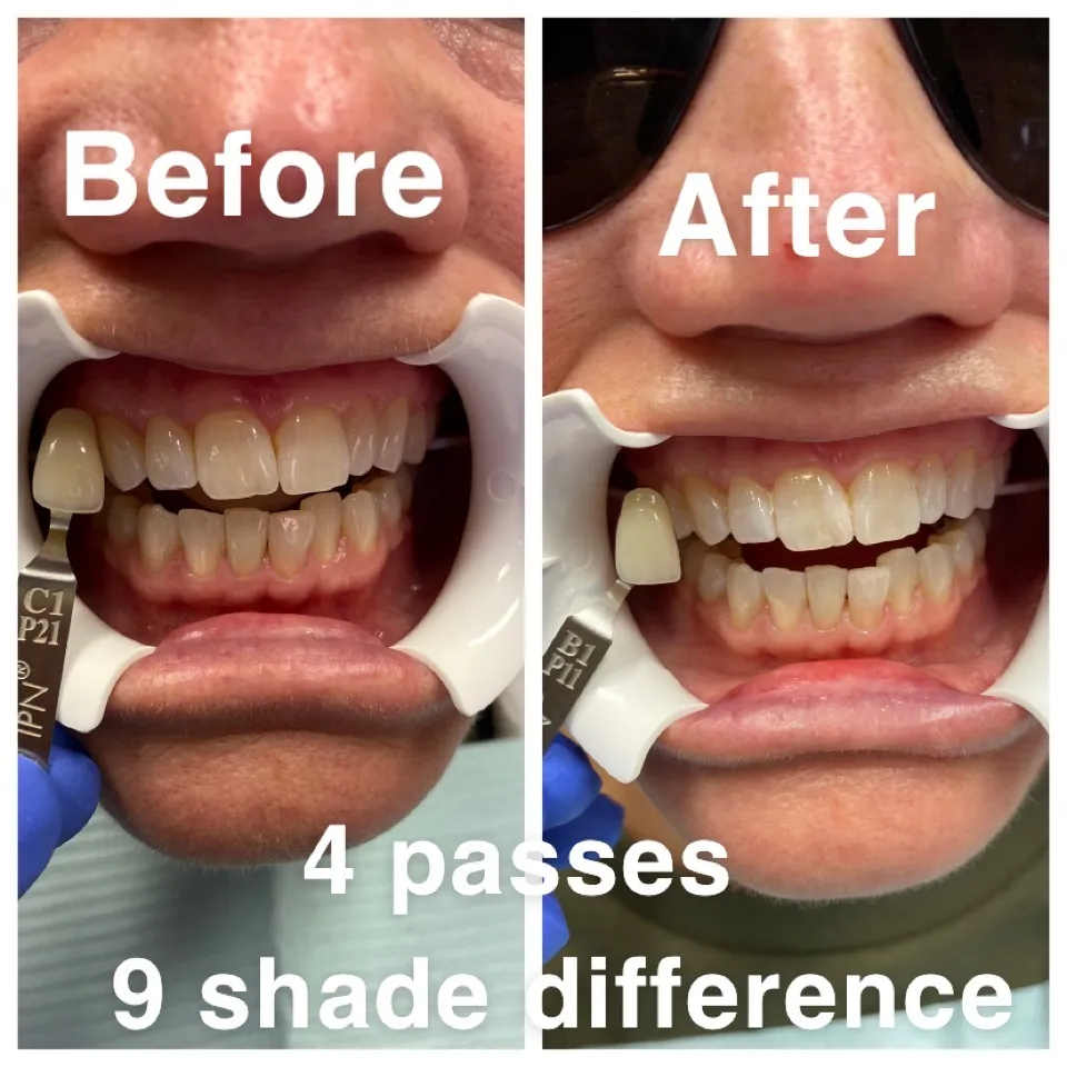 25757 teeth whitening florida image6