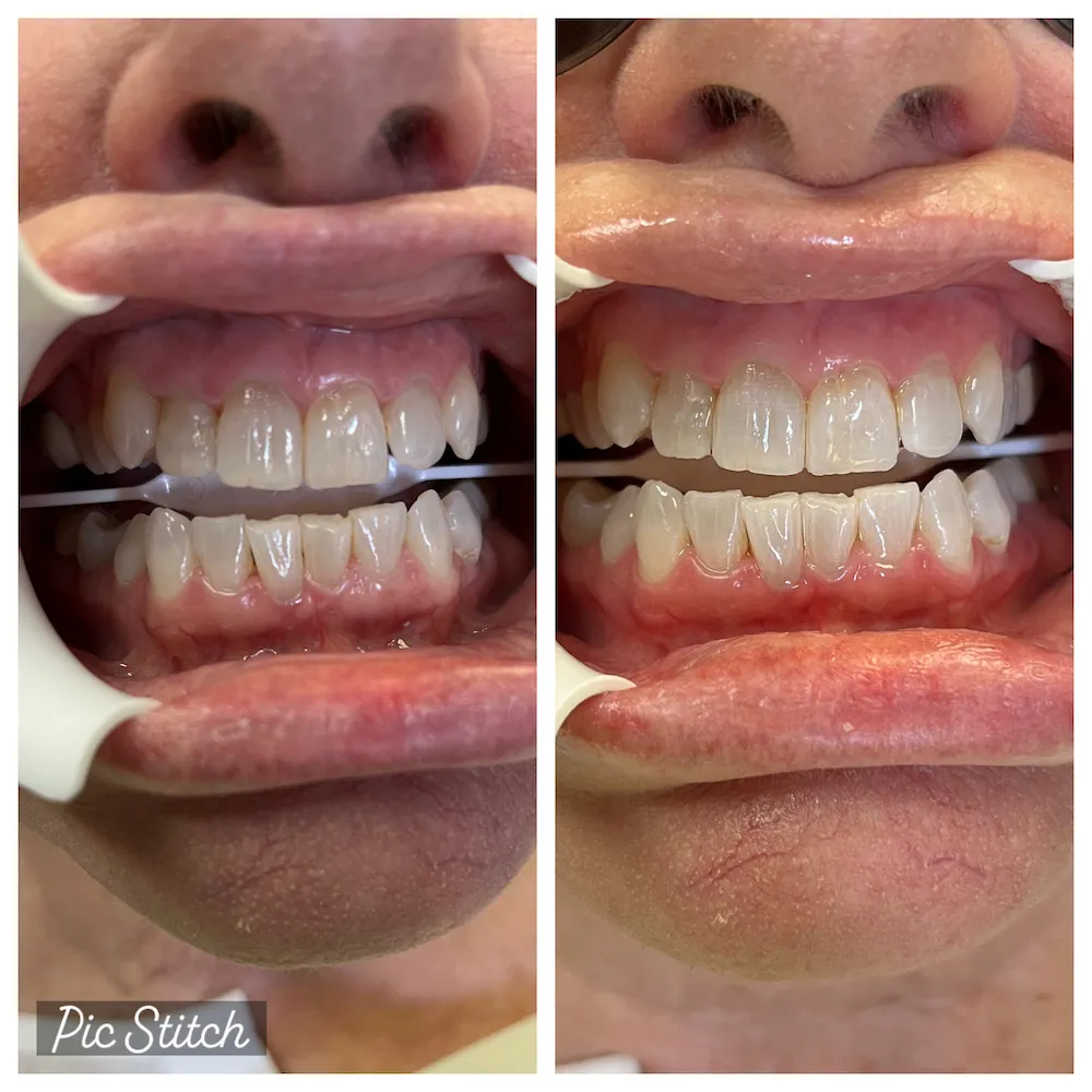 /img/25757-teeth-whitening-florida-image7.webp