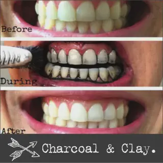 /img/25766-teeth-whitening-alternatives.webp