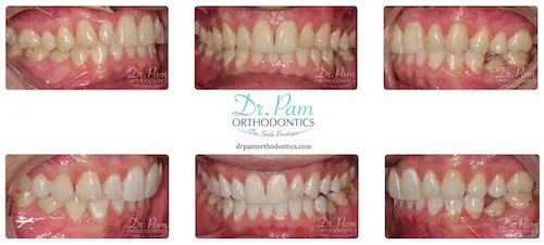25767 zoom whitening aftercare