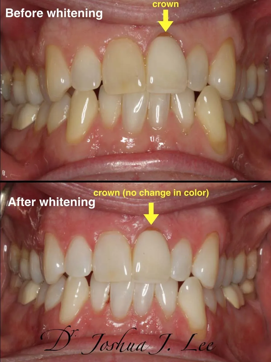 25767 zoom whitening lamp