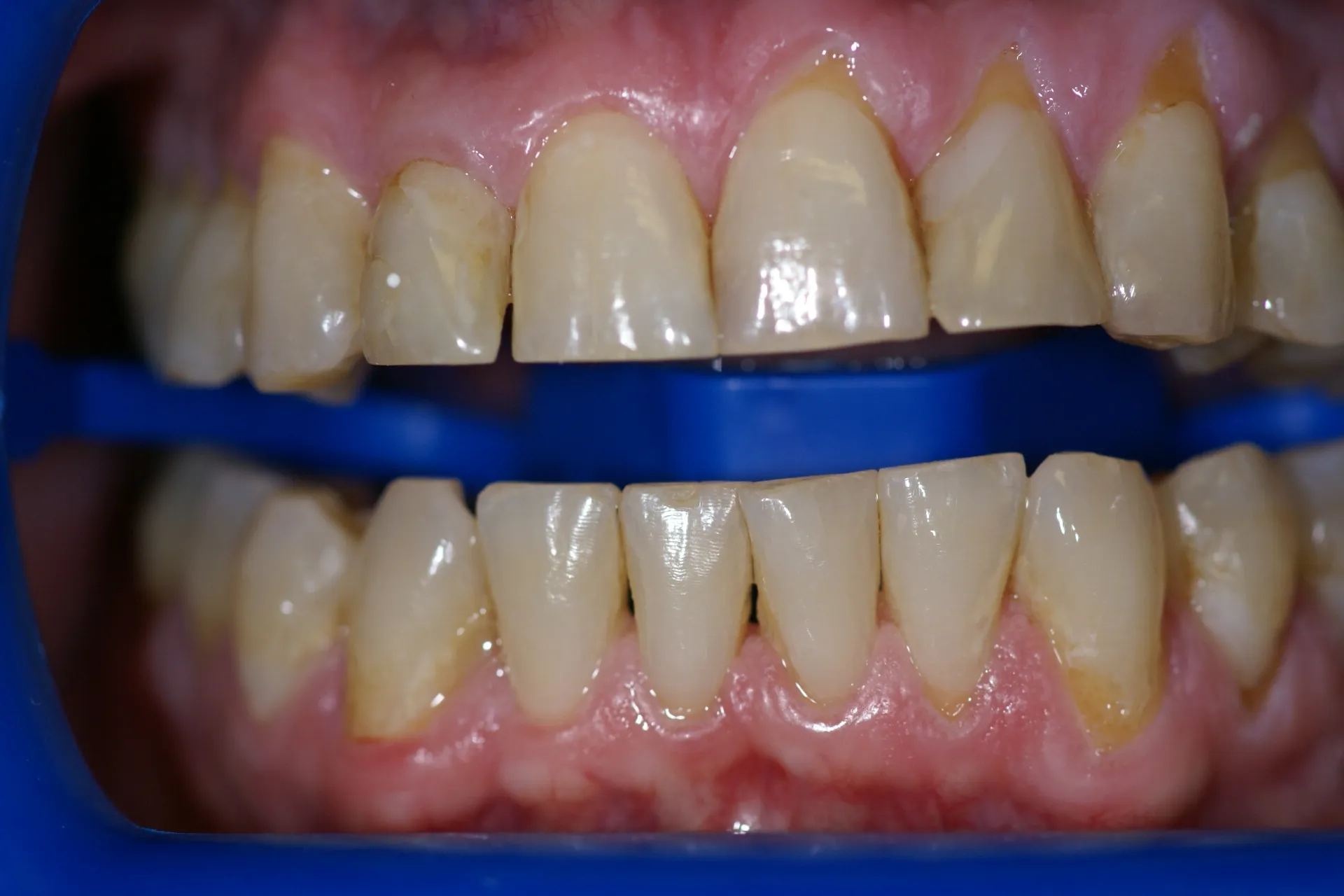 25767 zoom whitening results