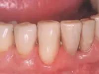 25770 at home teeth whitening