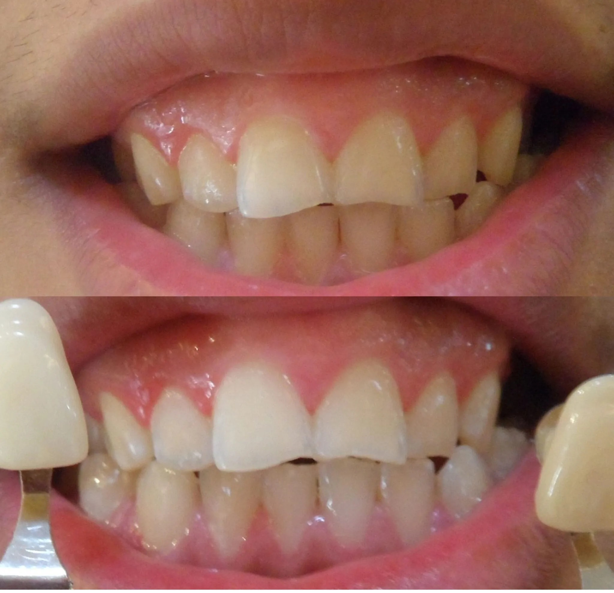 25773 at home teeth whitening