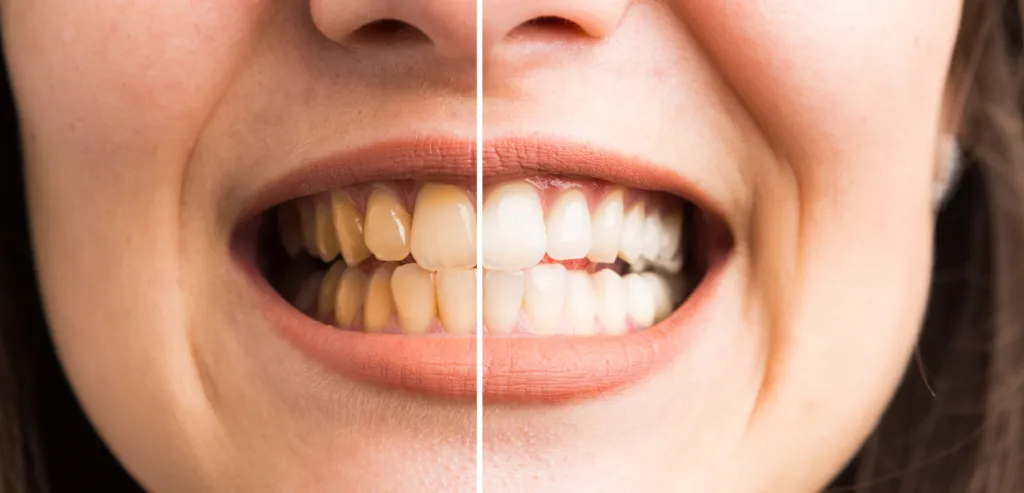 25773 teeth whitening cost