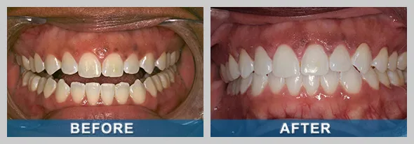 /img/25775-teeth-cleaning-checkup.webp