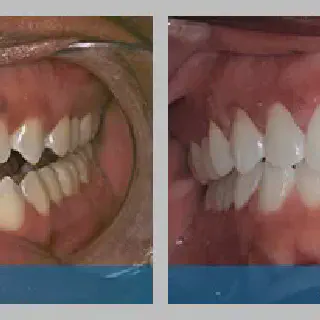/img/25775-teeth-cleaning-checkup.webp