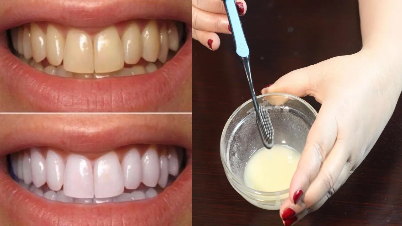 25776 tooth discoloration causes
