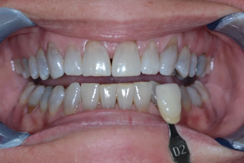 25781 davinci whitening procedure