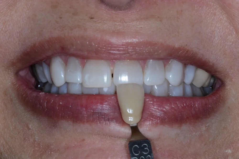 25781 teeth whitening comparison