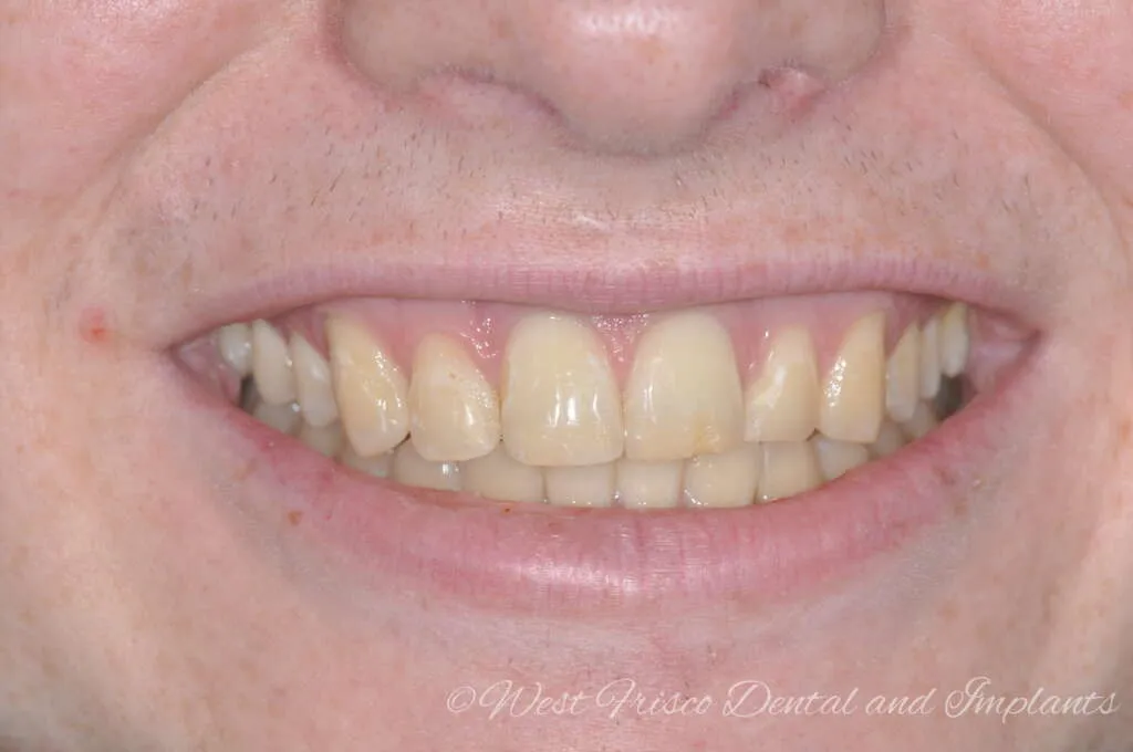/img/25784-zoom-teeth-whitening-seattle-maintenance.webp
