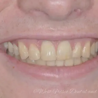 /img/25784-zoom-teeth-whitening-seattle-maintenance.webp