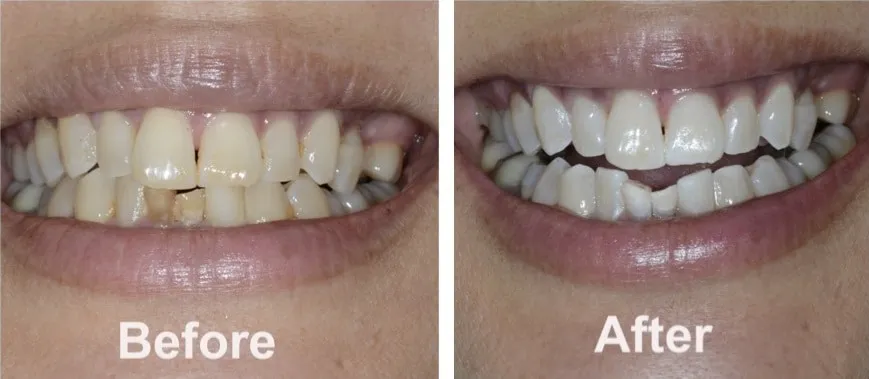 25784 zoom teeth whitening seattle professional