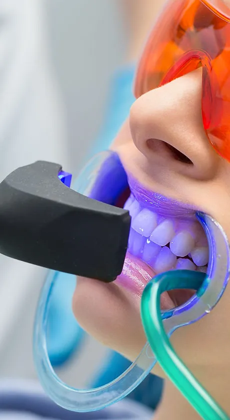 25784 zoom teeth whitening seattle stains