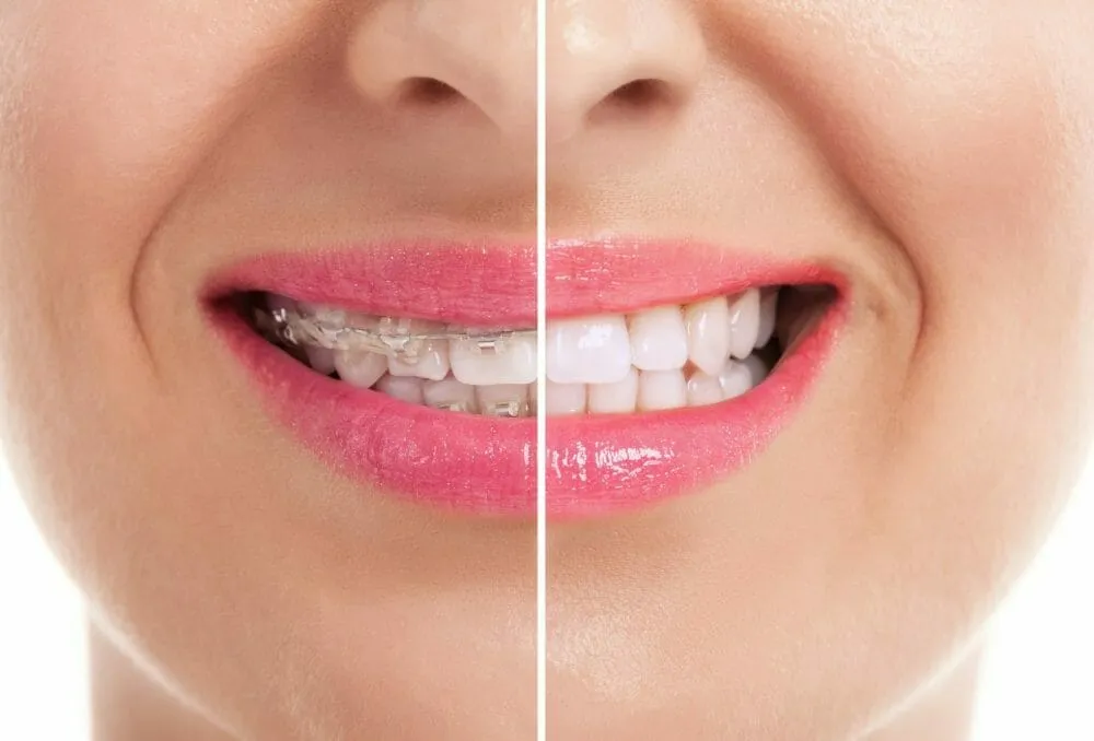 25785 at home teeth whitening kits