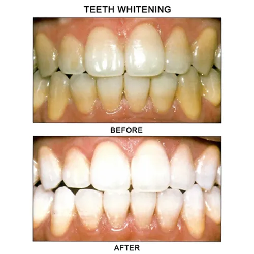 25785 teeth whitening maintain smile