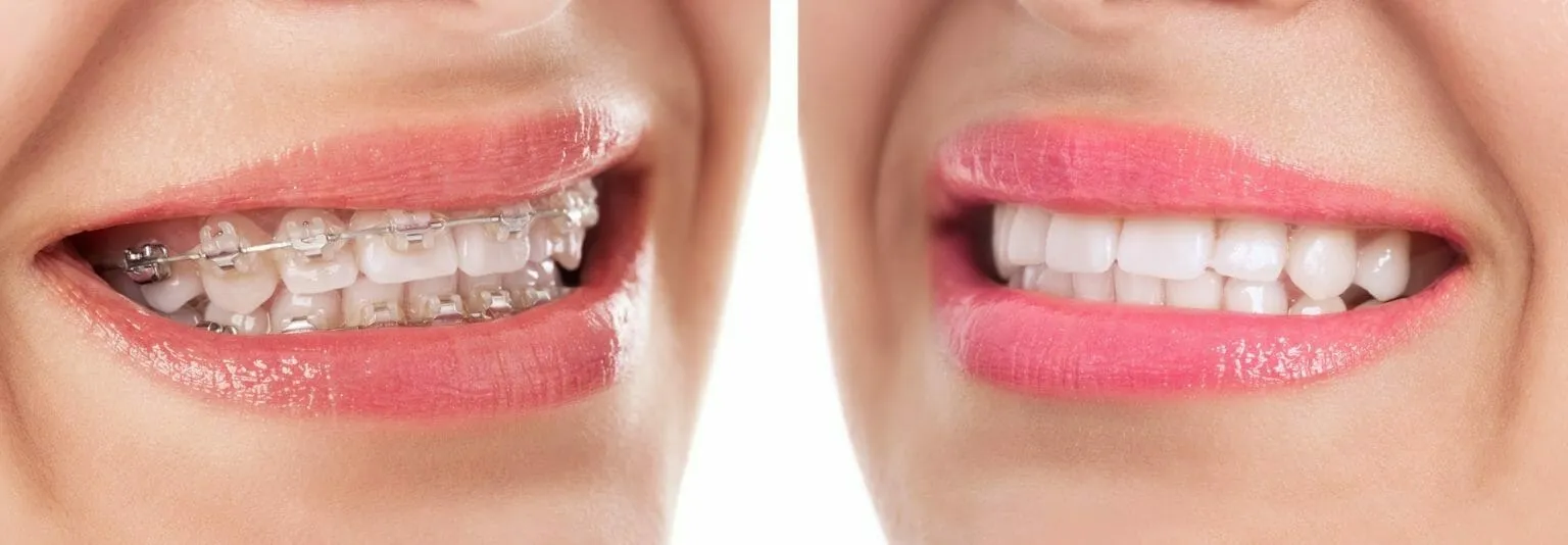 25785 teeth whitening sensitivity