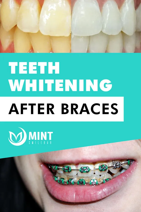 25785 teeth whitening uneven