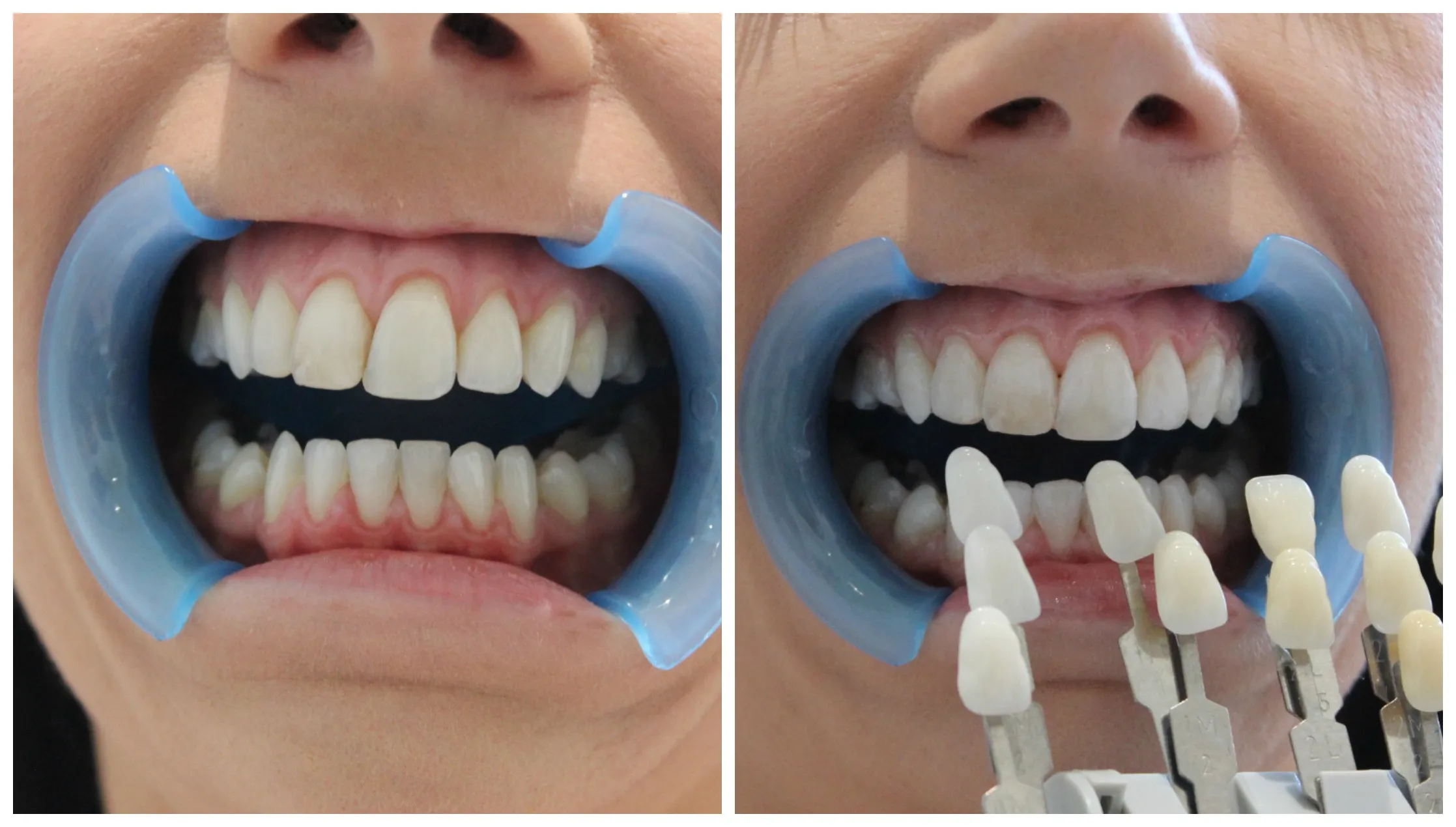 25789 teeth whitening near me image3