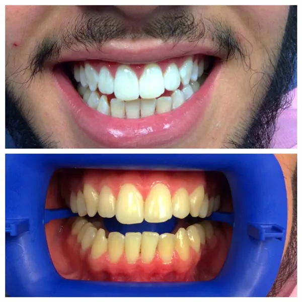 25789 teeth whitening near me image4
