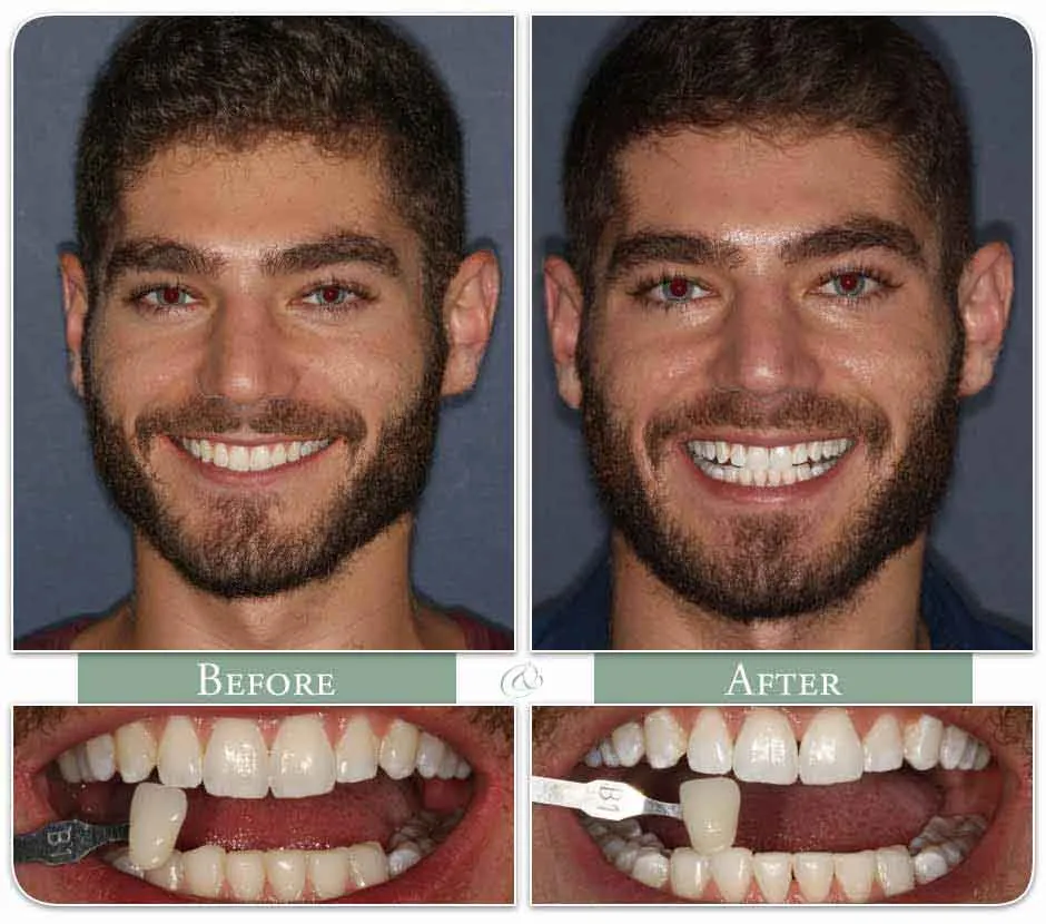 25789 teeth whitening near me image5